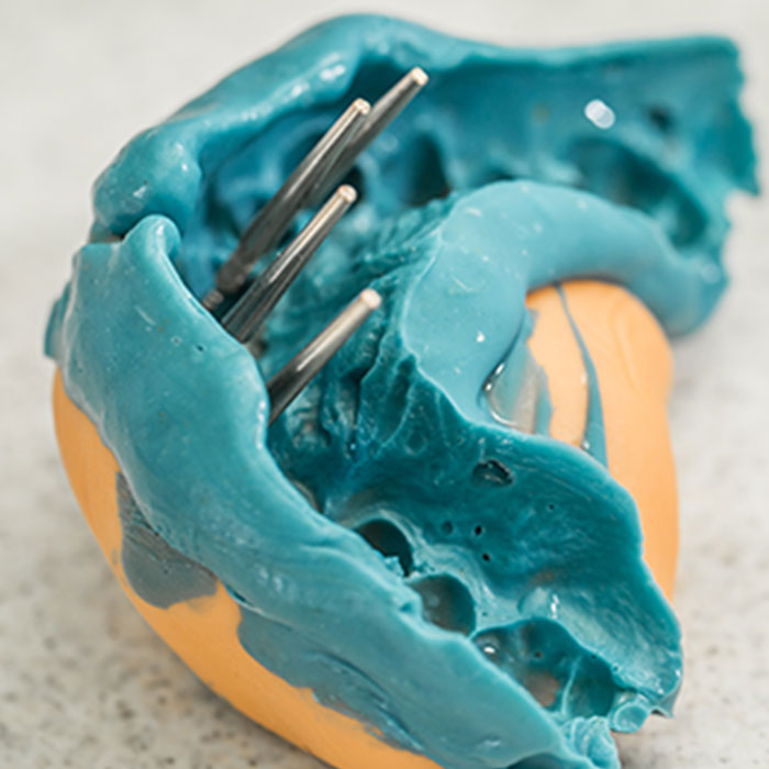 Denture impression for a reline