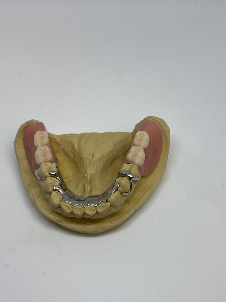 Partial Dentures Kasper Denture Clinic