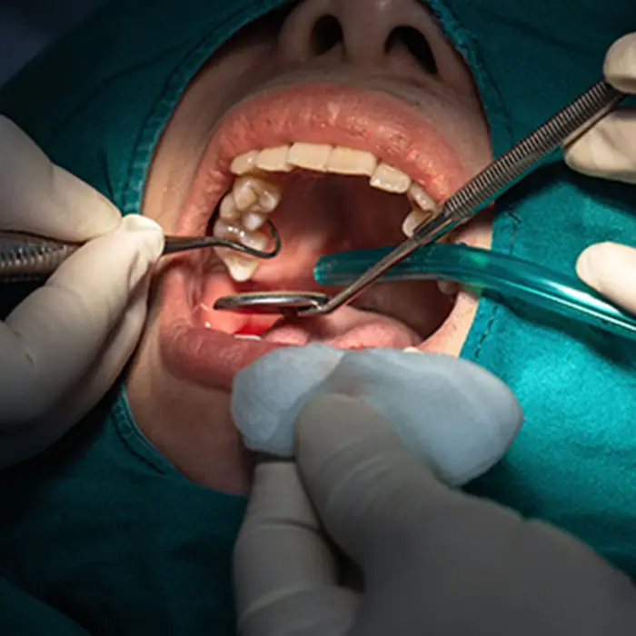 Close-up of a tooth extraction before immediate dentures