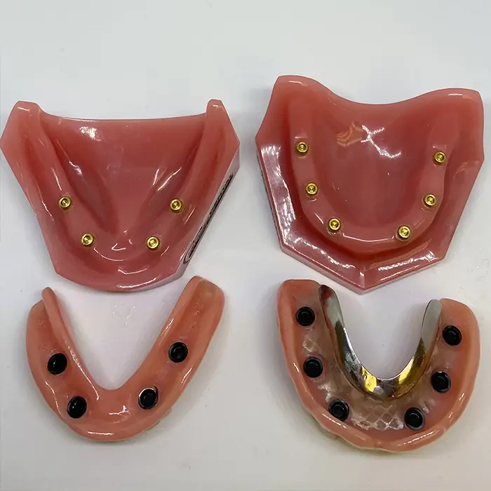 Implant overdenture being made in the lab
